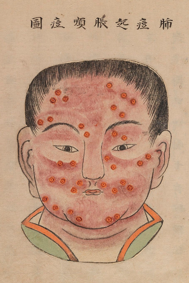 1720 Smallpox Illustration 5