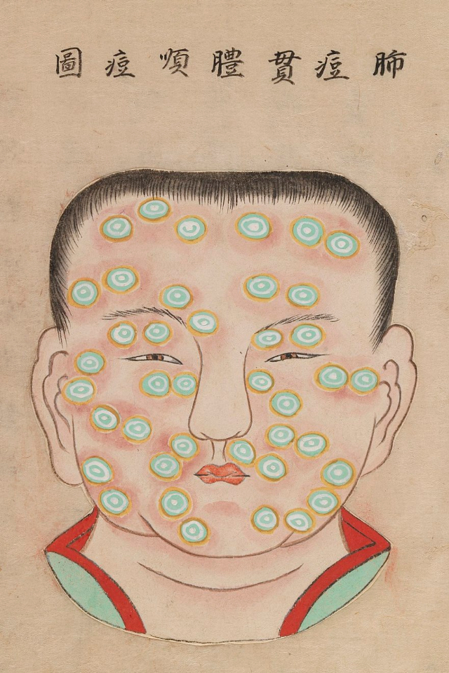 1720 Smallpox Illustration 6