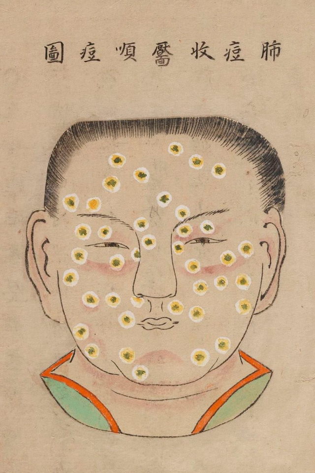 1720 Smallpox Illustration 7