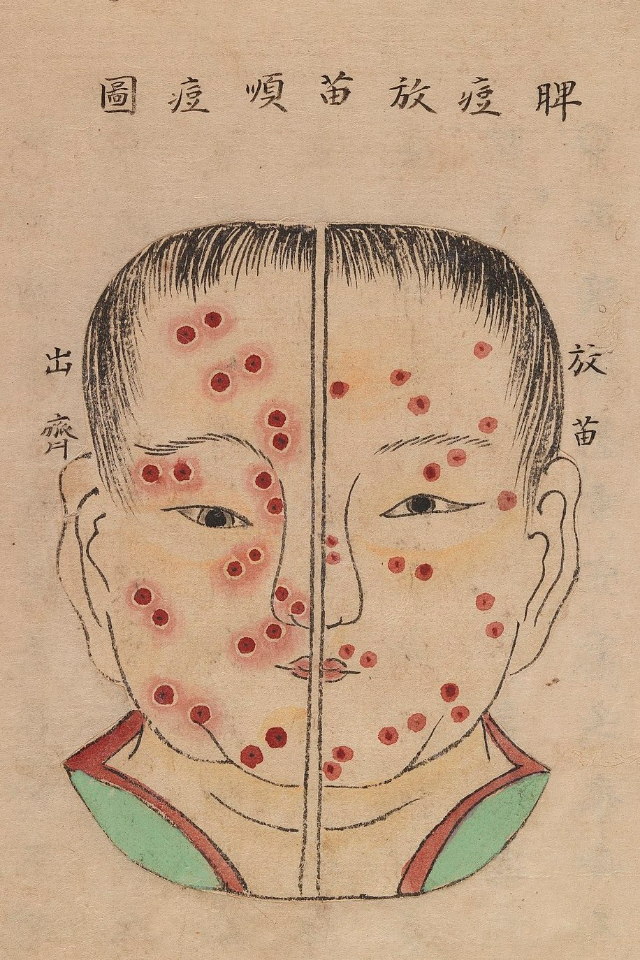 1720 Smallpox Illustration 8