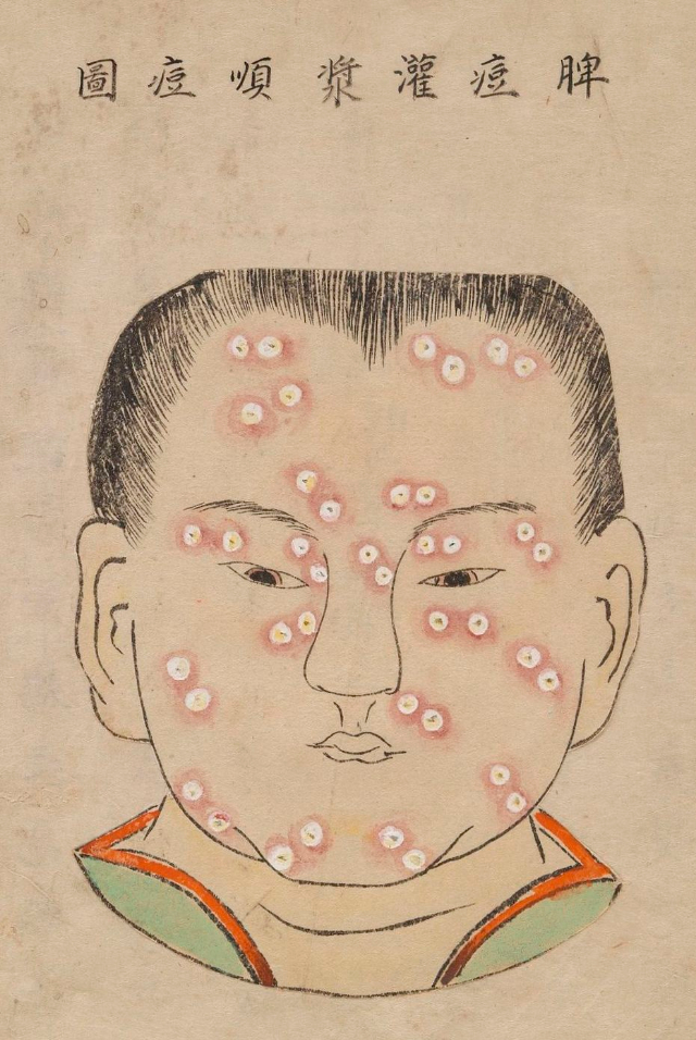 1720 Smallpox Illustration 9